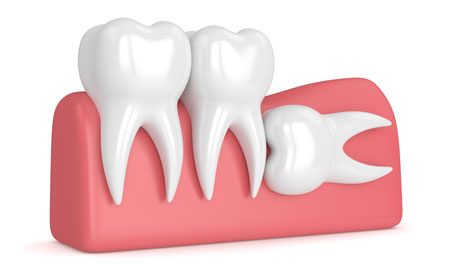 Wisdom tooth removal near me at Gachibowli