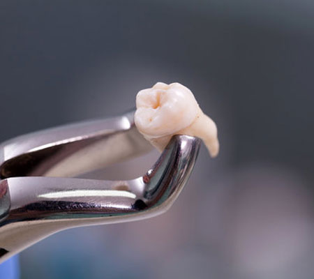 Wisdom tooth removal near me at Gachibowli