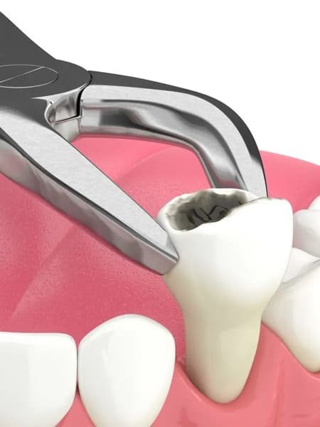 Wisdom tooth extraction