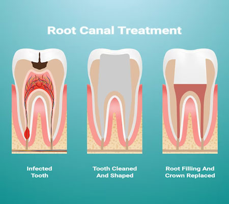 Root Canal Treatment Near me at Gachibowli Root Canal Treatment Near me at Gachibowli