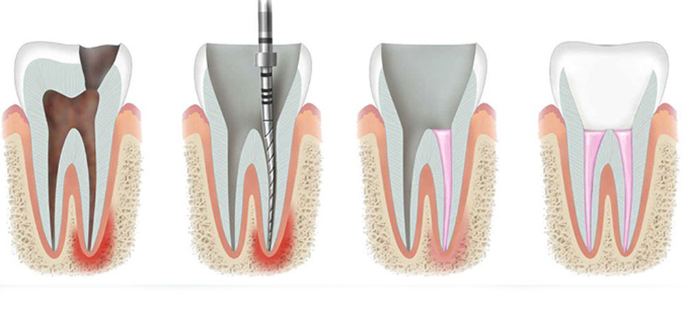 Root Canal Treatment Near me at Gachibowli Root Canal Treatment Near me at Gachibowli