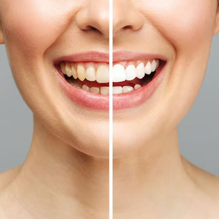 Teeth Whitening Near me at Gachibowli Teeth Whitening Near me at Gachibowli