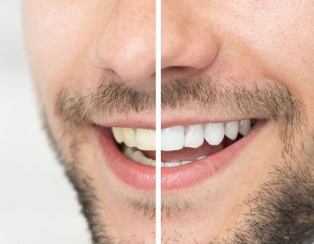Teeth Whitening Near me at Gachibowli Teeth Whitening Near me at Gachibowli
