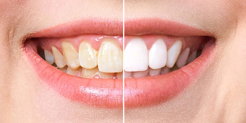 Teeth Whitening Near me at Gachibowli Teeth Whitening Near me at Gachibowli