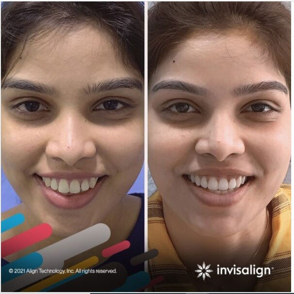 Invisalign