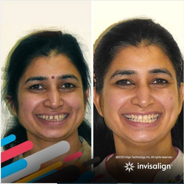 Invisalign