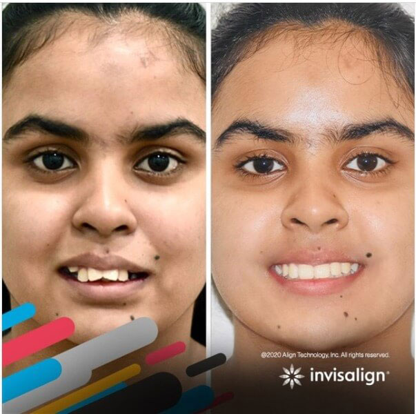 Invisalign